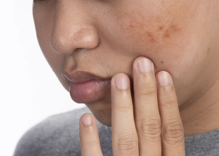 Understanding Dark Spots and How They Are Commonly Addressed